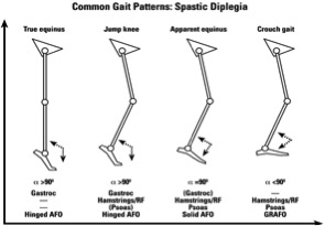 Cerebral Palsy Surgery