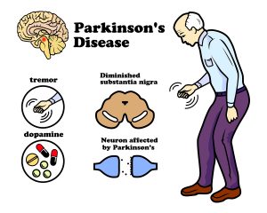 Parkinson's Disease